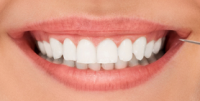 Appareils d'orthodontie esthétique invisible invisalign 